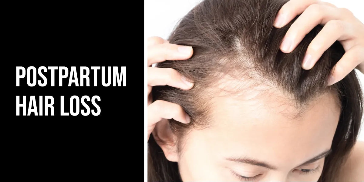 Postpartum Hair Loss