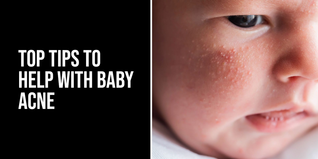 Top Tips to Help With Baby Acne